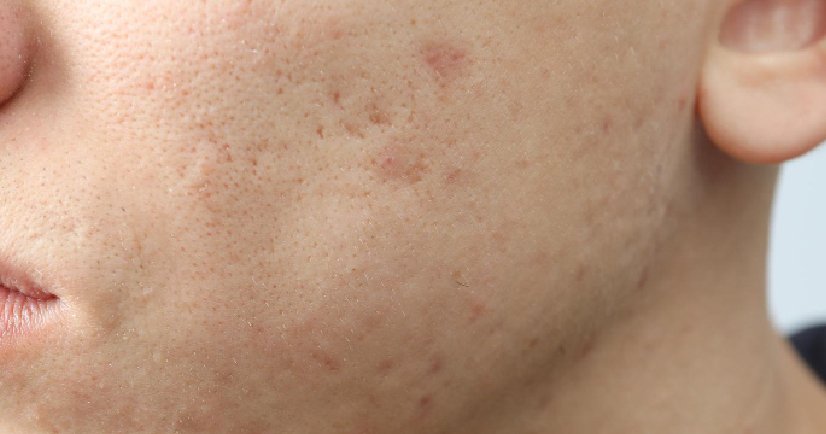 acne scar treatment in bangalore