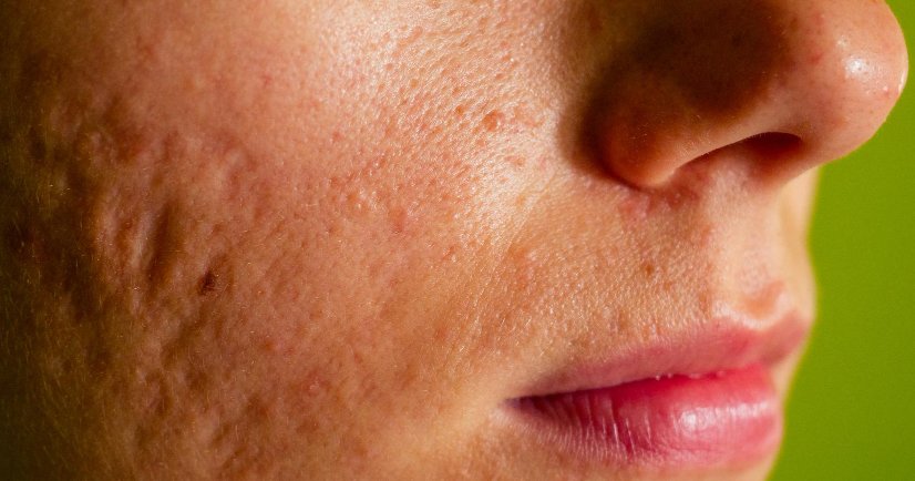 acne scar treatment in bangalore