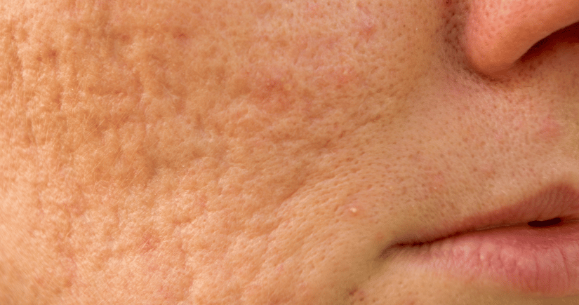 acne scar treatment in bangalore