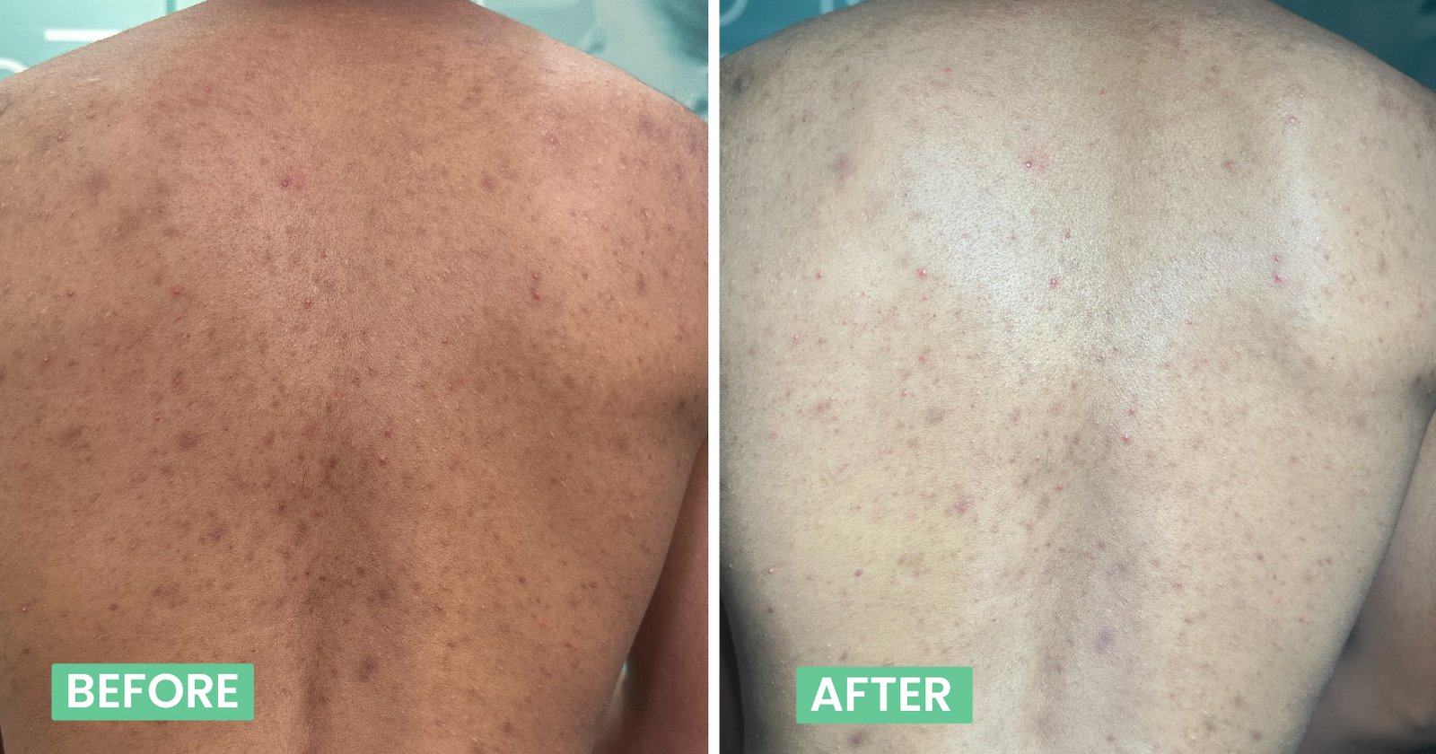 Pigmentation Treatment In Bangalore