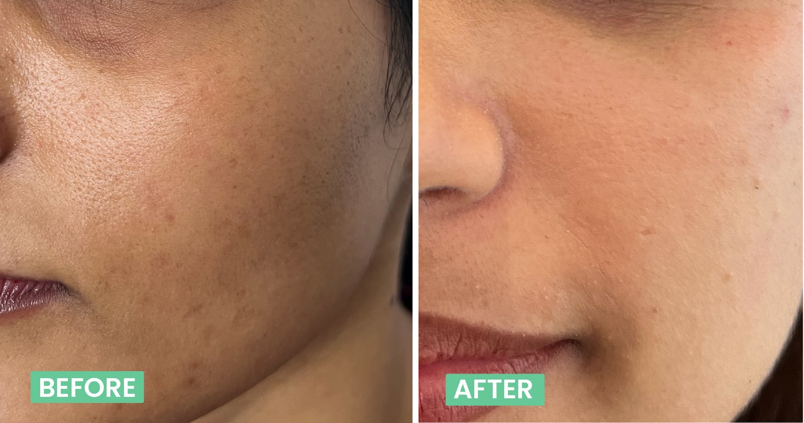 Pigmentation Treatment In Bangalore