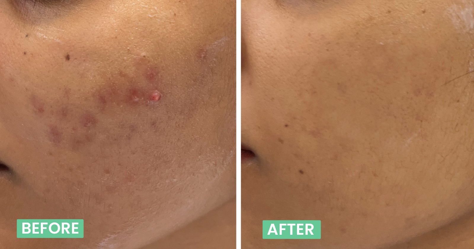 acne scar treatment in bangalore