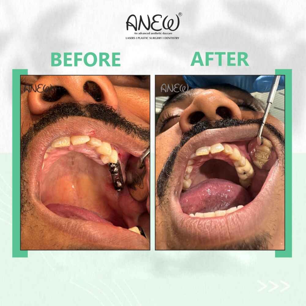 Irfan Before and After image