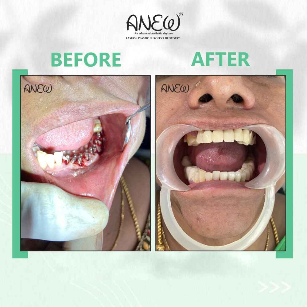 Vasanthi Before and After image