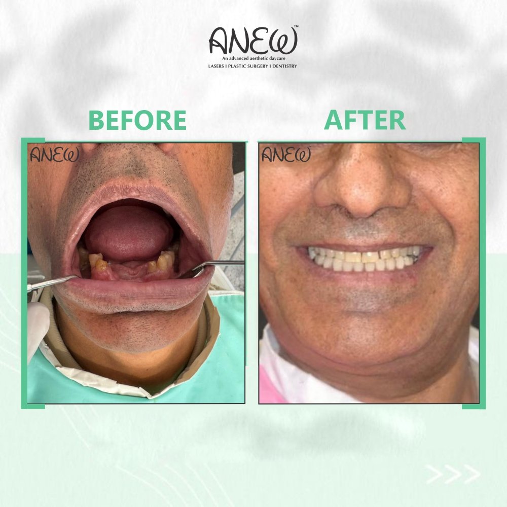  Lower Implant Before and After image1