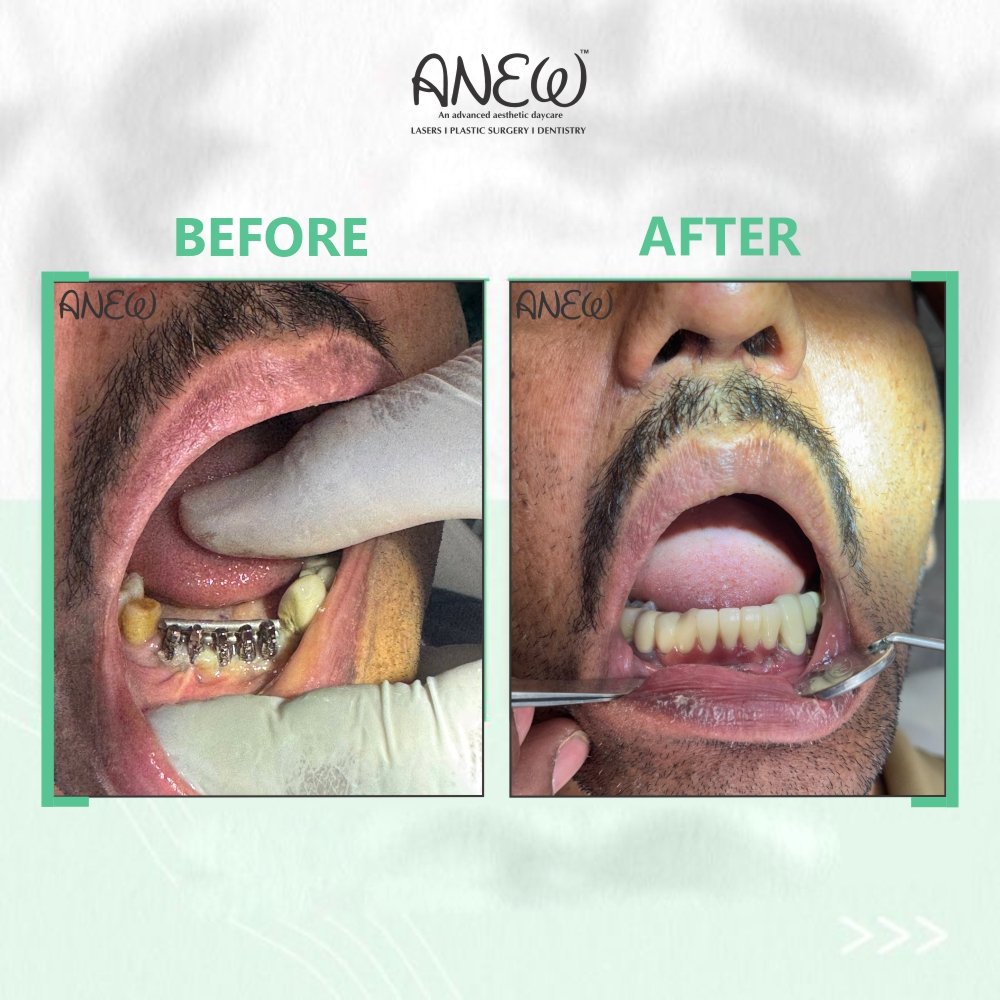  Lower Implant Before and After image