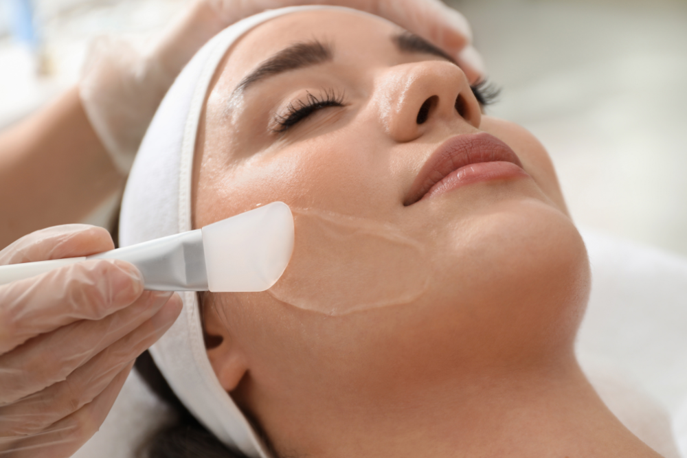 Chemical peel treatment for active acne