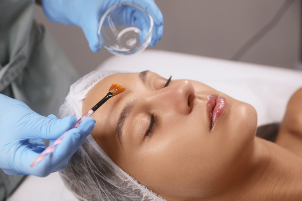 Chemical peel treatment for active acne