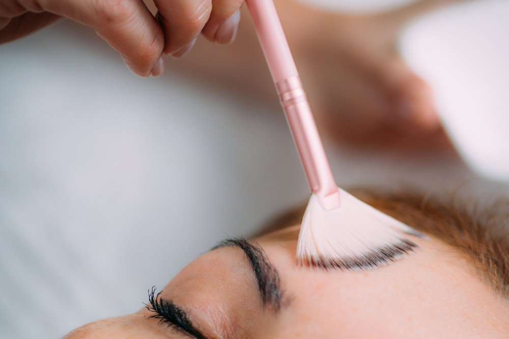 Chemical peel application for acne-prone skin