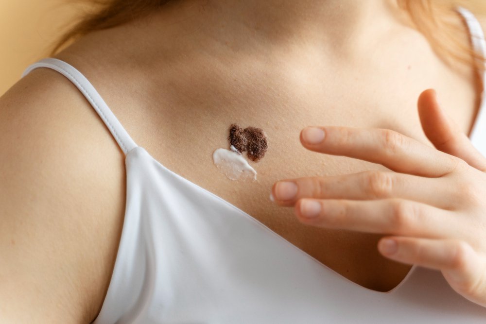 can keloid be completely removed and gone forever