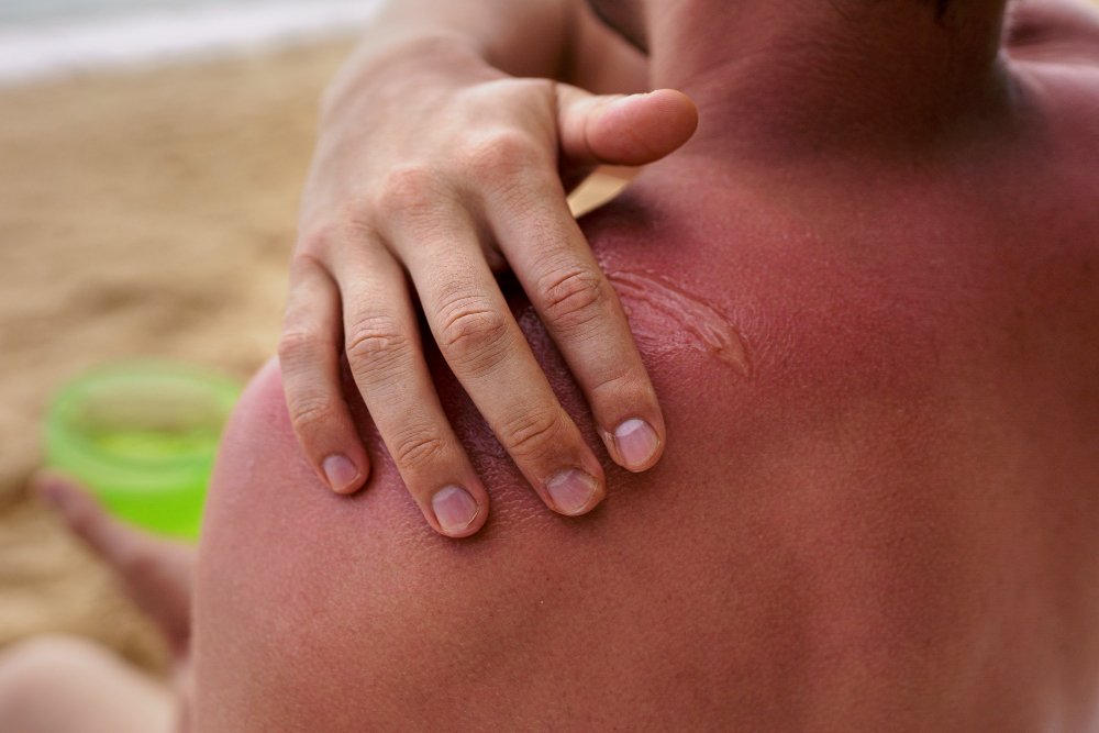 can keloid be removed permanently