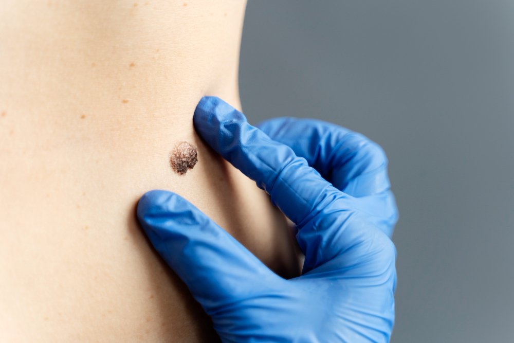will a keloid be gone forever after treatment