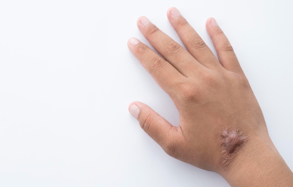 can keloid be removed permanently
