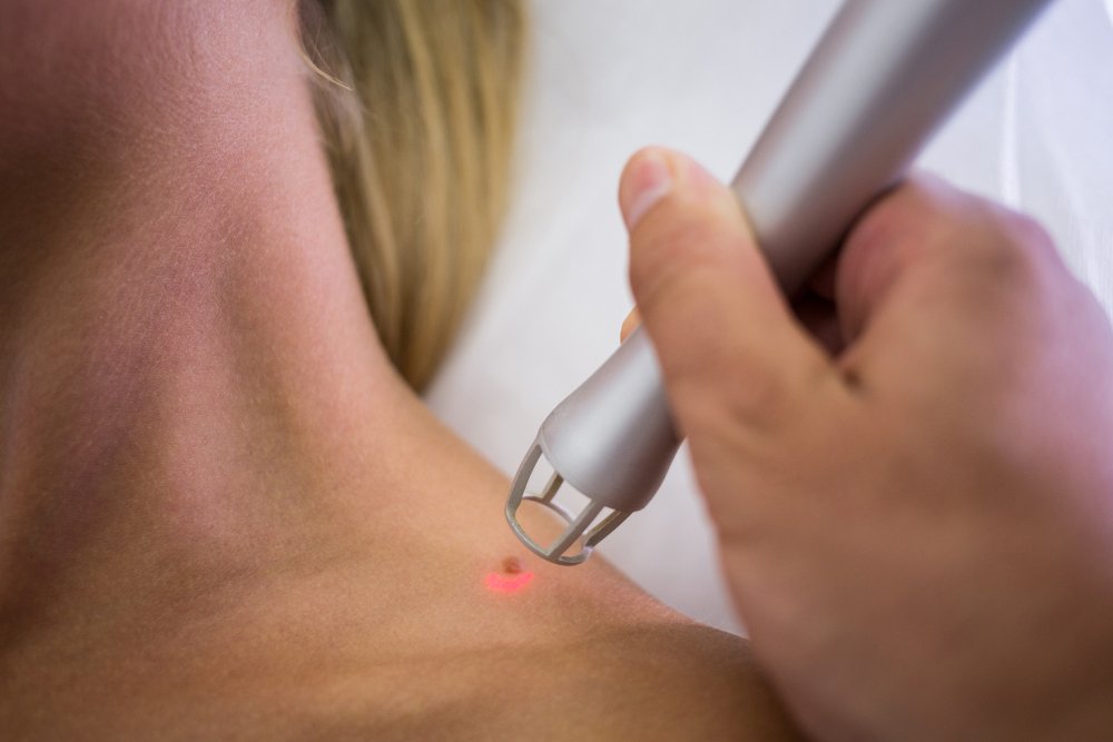 can keloid be removed permanently