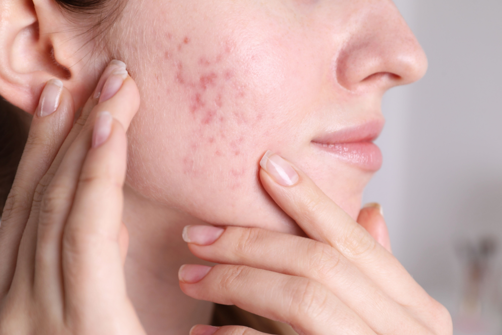 can chemical peels help acne scars