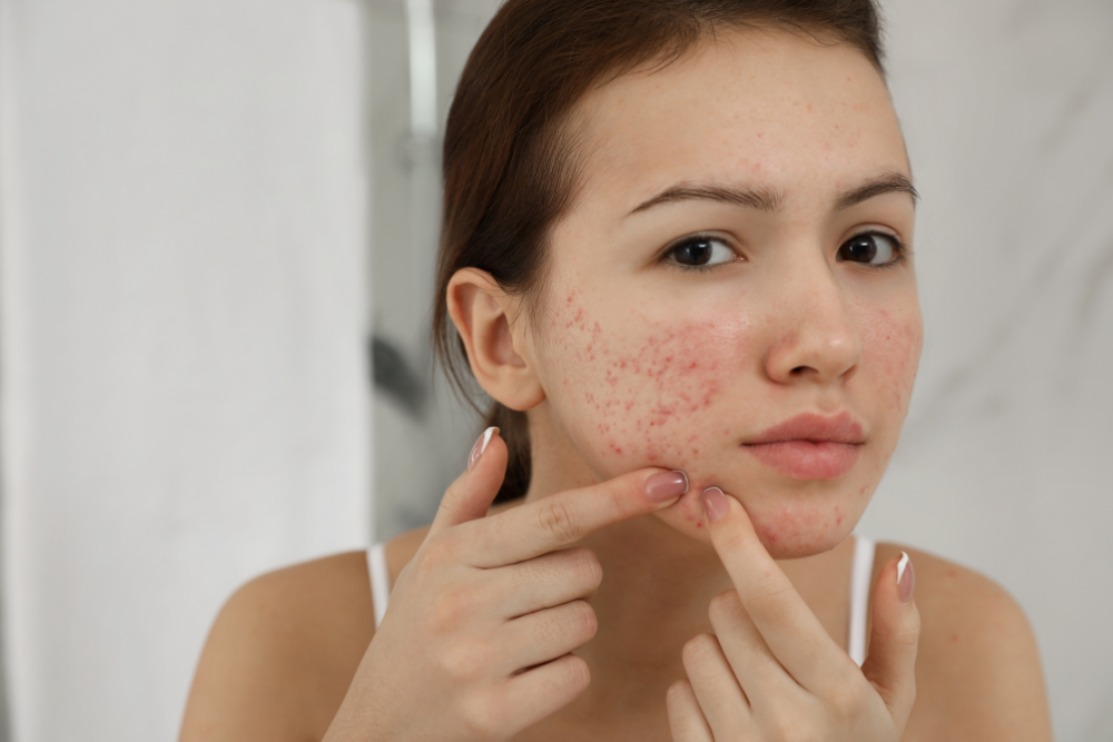 will chemical peels help my acne scars