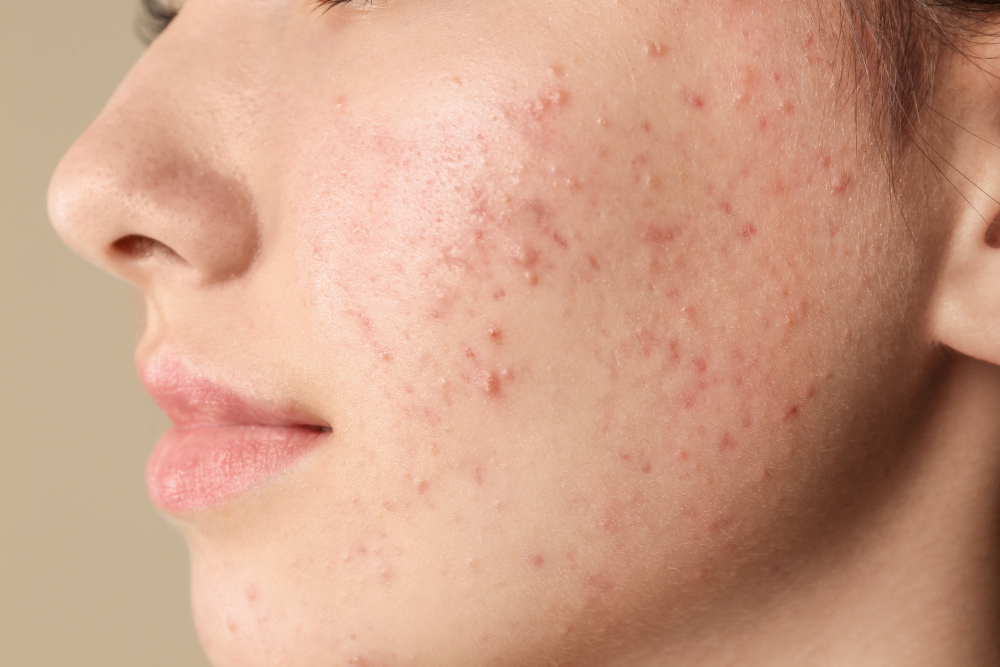 can i get chemical peels done for acne scars