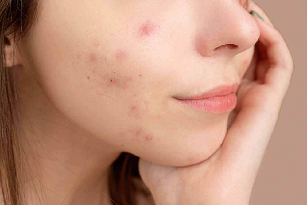 chemical peel treatment for acne scars