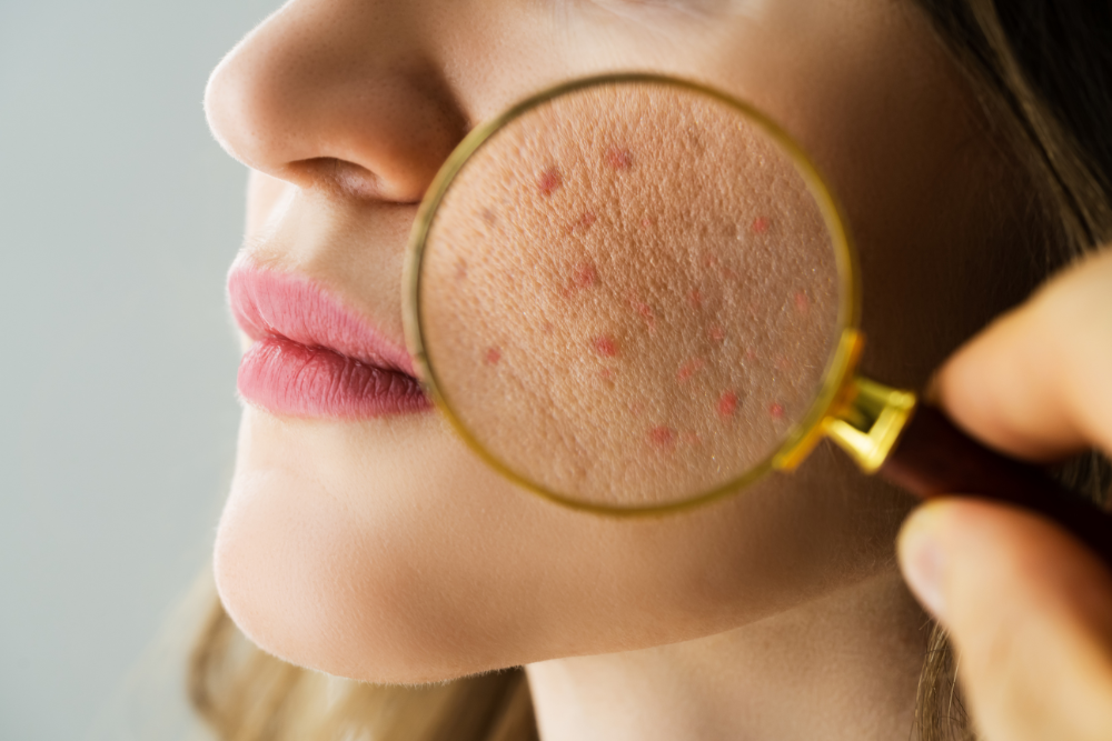 chemical peel for acne scars