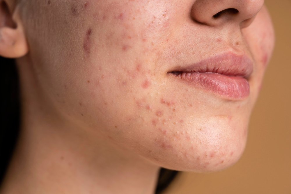 results after an acne scar treatment