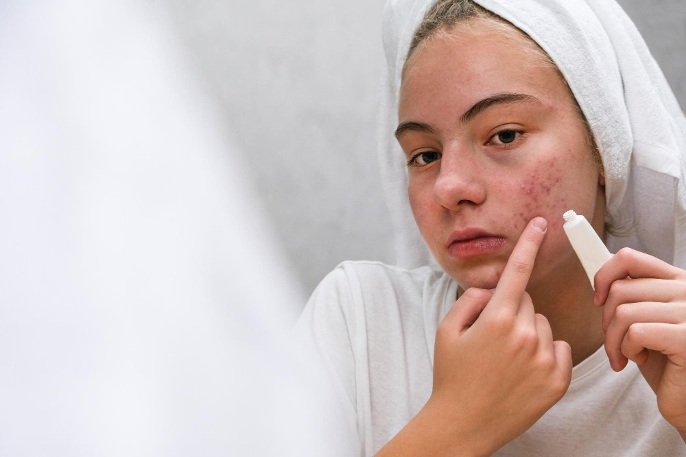 when will I see results after an acne scar treatment