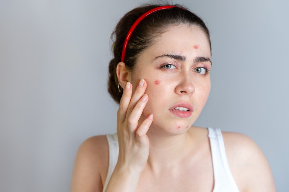 when will I see results after an acne scar treatment