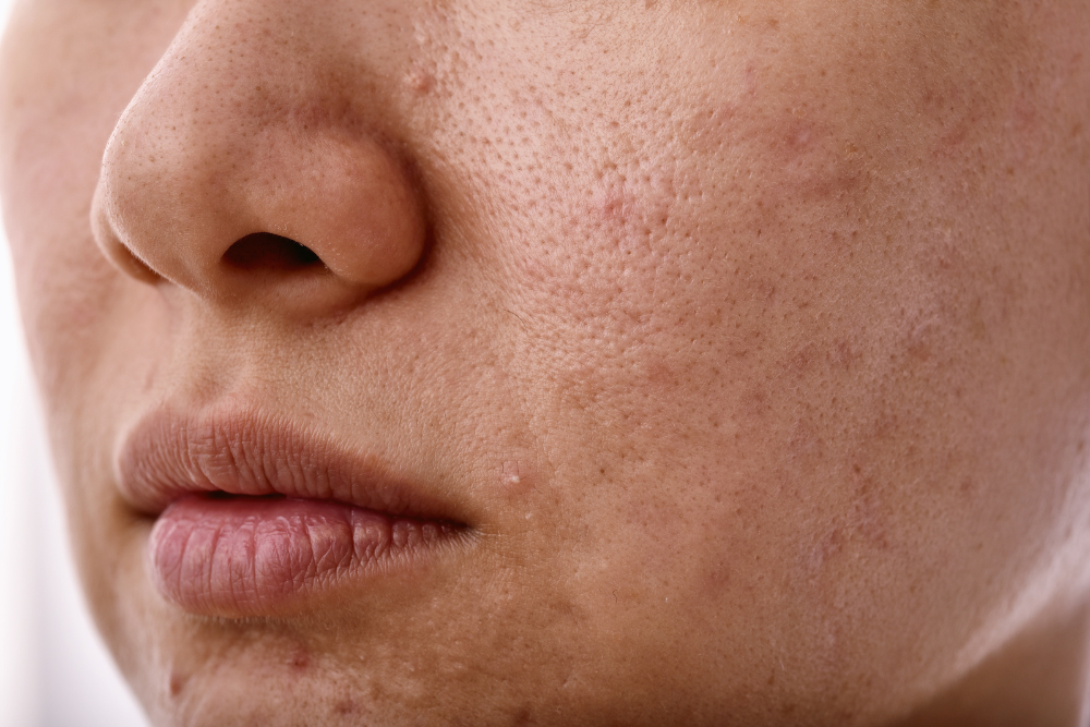 What is the best treatment for uneven skin tone