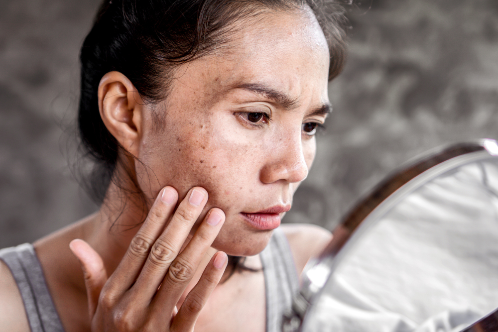 what is the difference between pigmentation and melasma