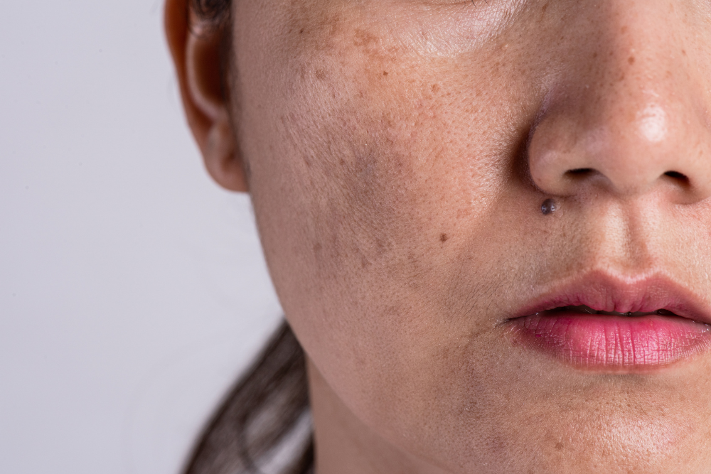 Reasons why I have pigmentation on my face