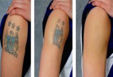 Laser Tattoo Removal in Goa