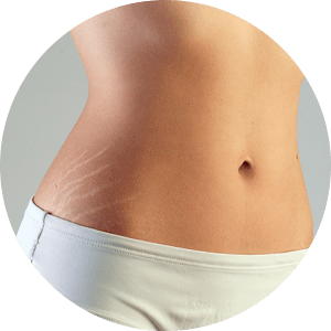 Stretch Marks Removal in Goa