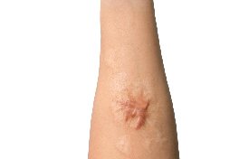 laser treatment for keloids cost