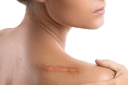 keloid scar treatment