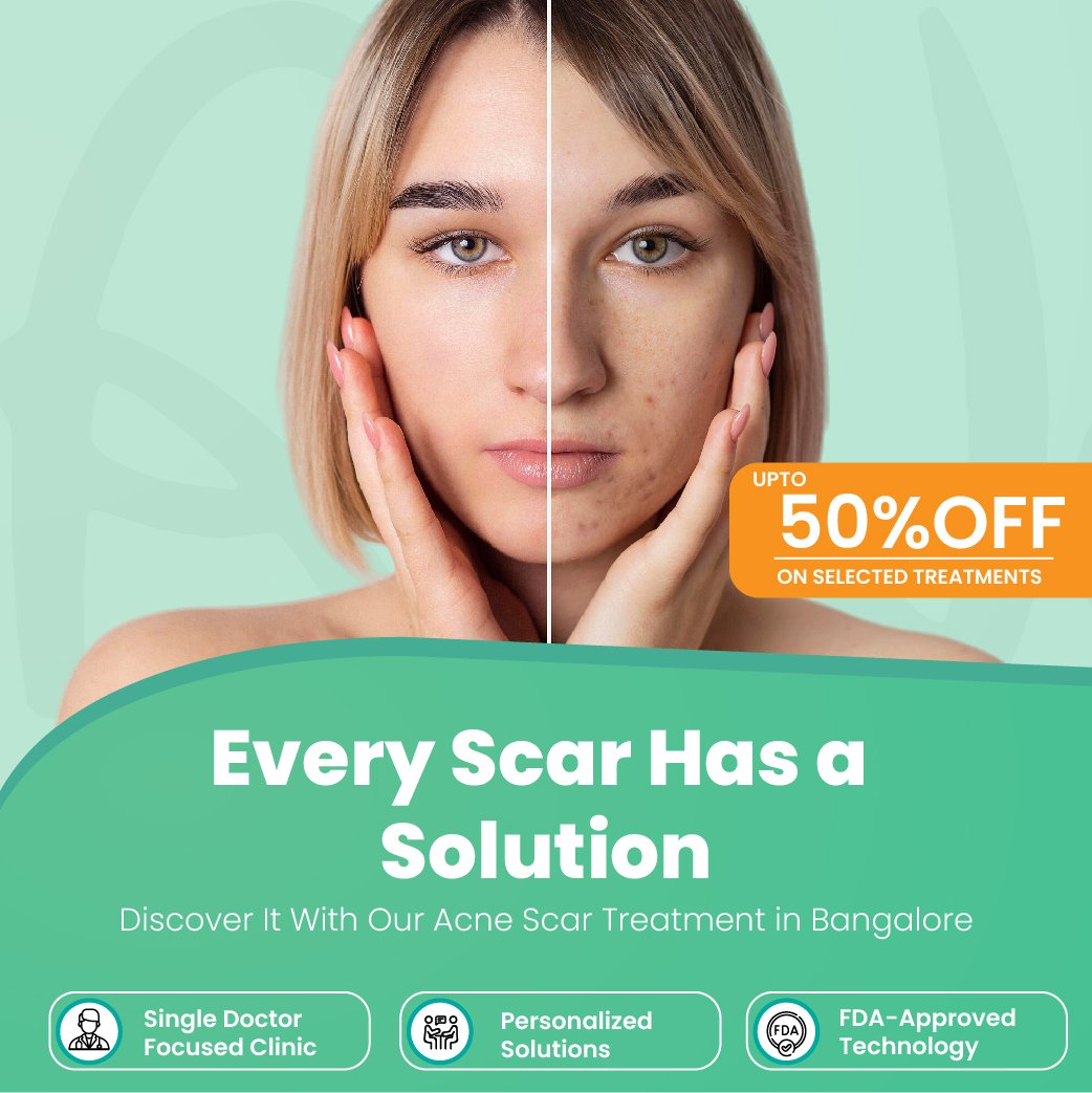 acne scar treatment in bangalore
