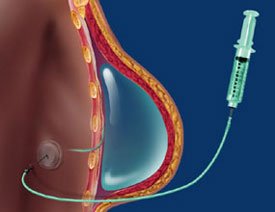 Breast Reconstruction Surgery in Bangalore