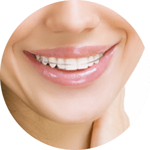 Orthodontic Treatment in Banashankari