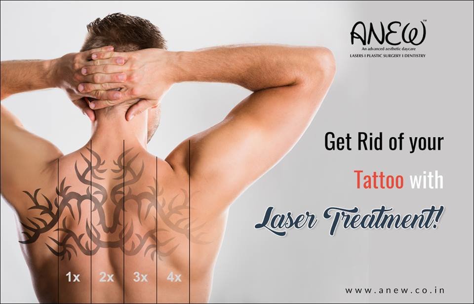 Laser Tattoo Removal in Bangalore | Laser Tattoo Removal Cost in Bangalore  - Anew