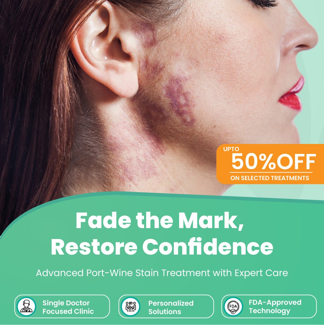 Port Wine Stains Treatment In Bangalore