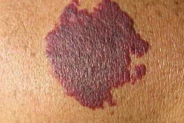 Red Port Wine Stains