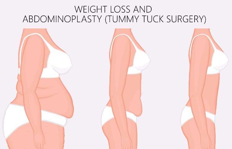 Tummy tuck surgery in Bangalore - ANEW