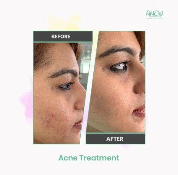Best Advanced Acne and Pimple Treatment in Bangalore