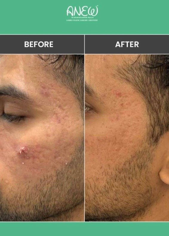 Best Advanced Acne and Pimple Treatment in Bangalore
