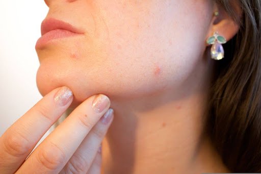 Lumenis Laser Skin Resurfacing