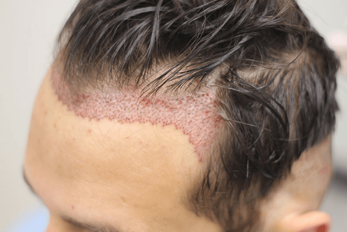 Anew’s Shave-Free FUE: The Revolutionary Hair Transplant Technique