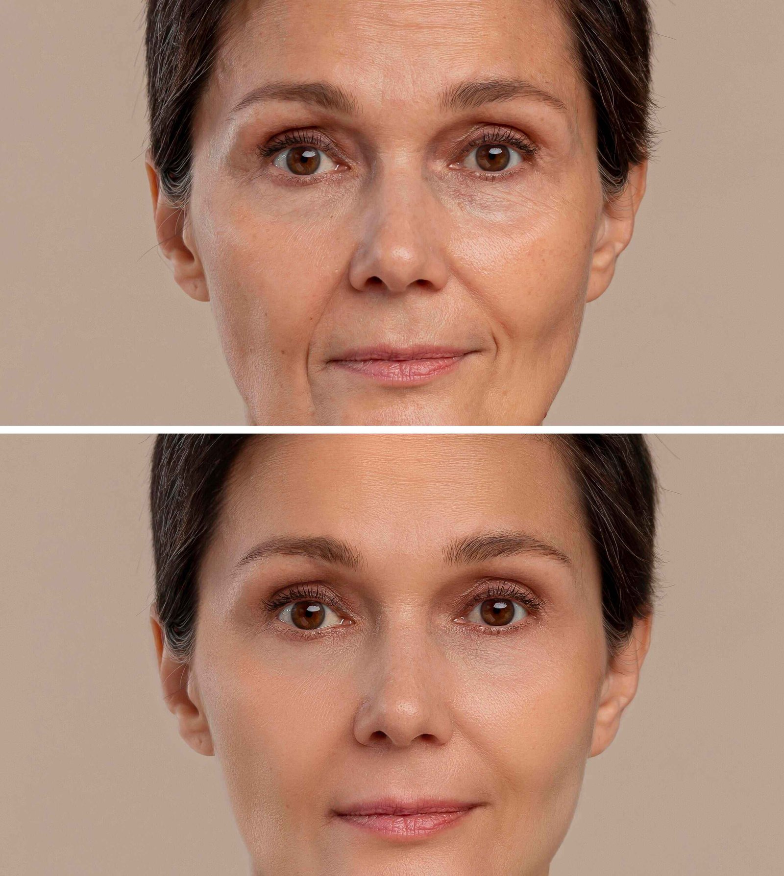 Botox Before After