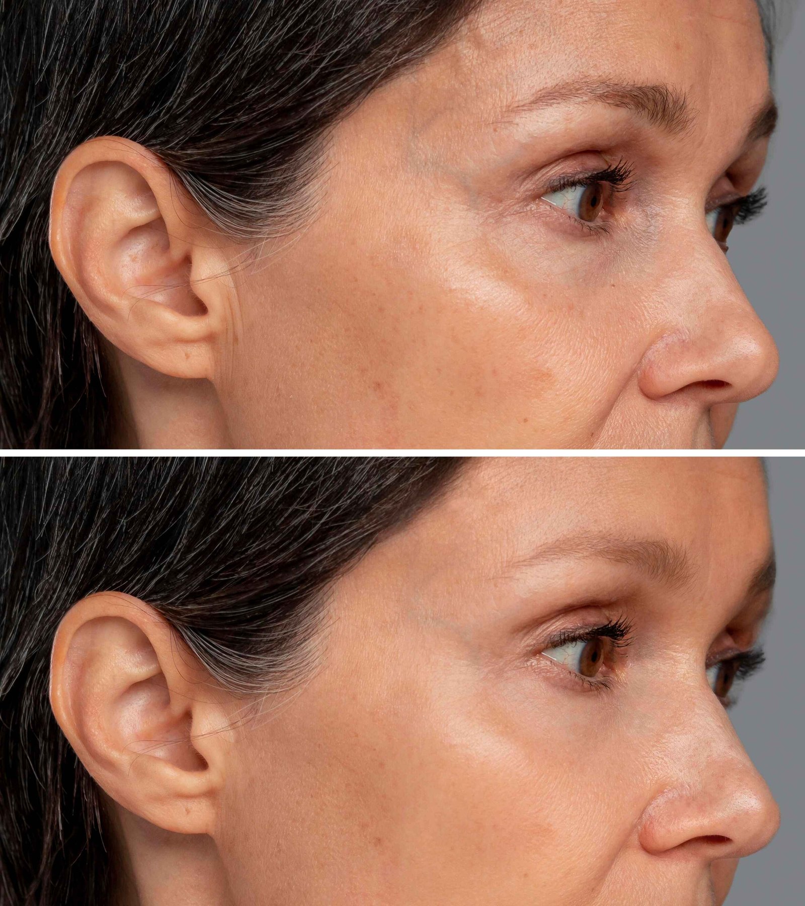 Botox Before After