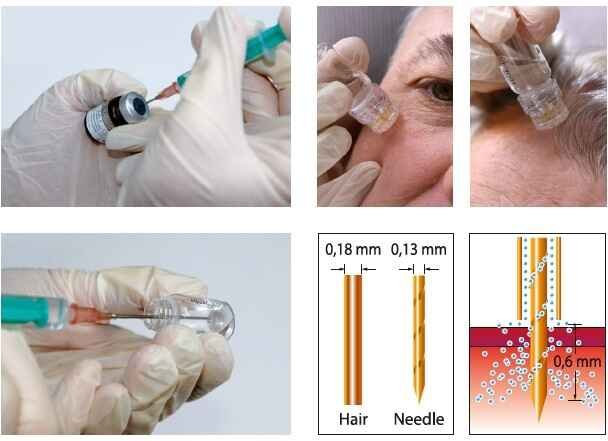 AquaGold Fine Touch – Skin Rejuvenation Treatment Bangalore