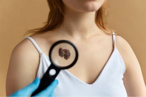 are keloids dangerous do they go away on their own