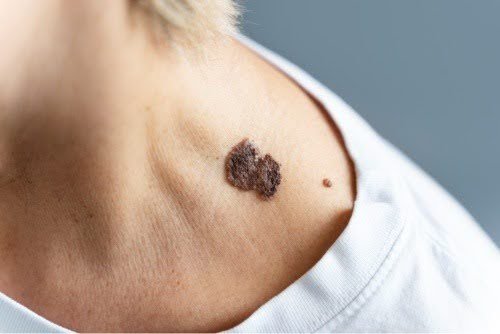 do keloids go away on their own