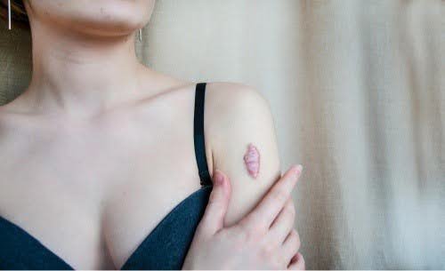 keloid scar symptoms and causes